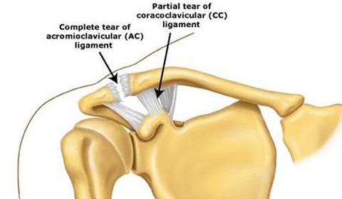 Acromioclavicular (AC) Joint Sprain
