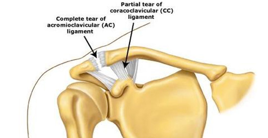 Acromioclavicular (AC) Joint Sprain