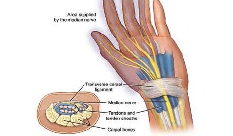 Carpal Tunnel Syndrome