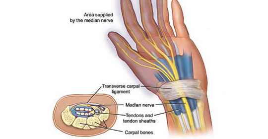 Carpal Tunnel Syndrome