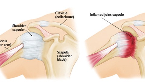 Adhesive Capsulitis or ‘Frozen Shoulder’