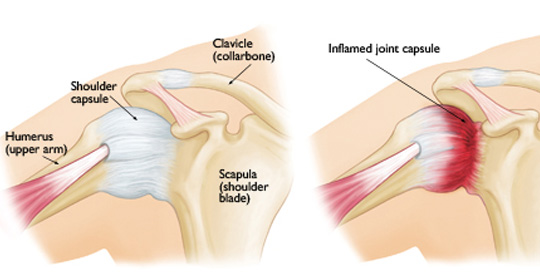 Adhesive Capsulitis or ‘Frozen Shoulder’