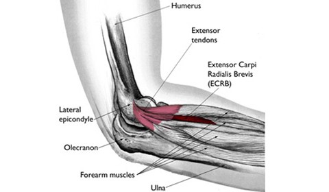 Lateral Epicondylalgia (Tennis Elbow)