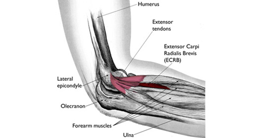 Lateral Epicondylalgia (Tennis Elbow)